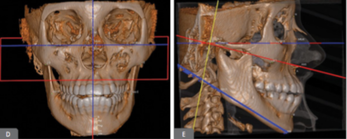 Análise tomográfica para diagnóstico ortodôntico