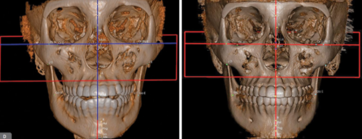 Imagem tomográfica mostrando o resultado da aplicação das miniplacas.